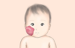 乳児血管腫（いちご状血管腫）
