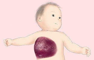 乳児血管腫以外の血管性腫瘍