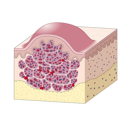 カポジ肉腫様血管内皮細胞腫に発症した カサバッハ・メリット現象（症候群）のイメージ