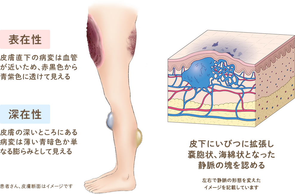 腫瘍・母斑・血管奇形 - 健康/医学